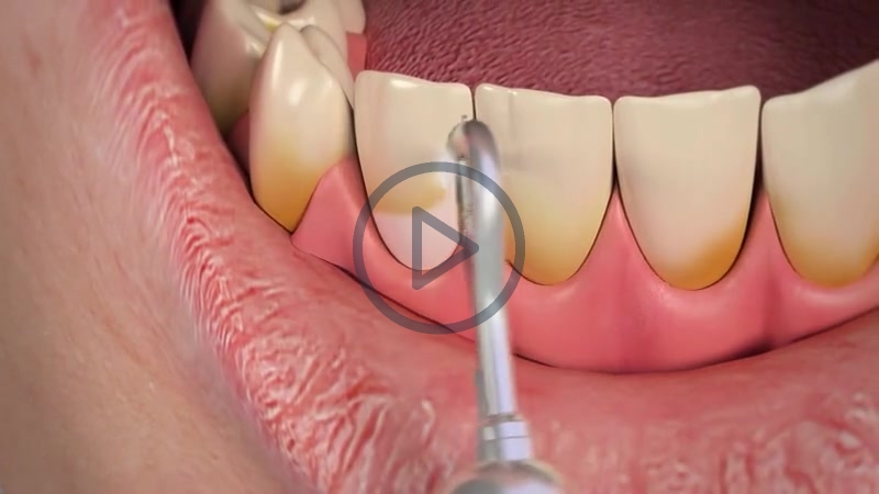 Fluid abrasion - Cleaning