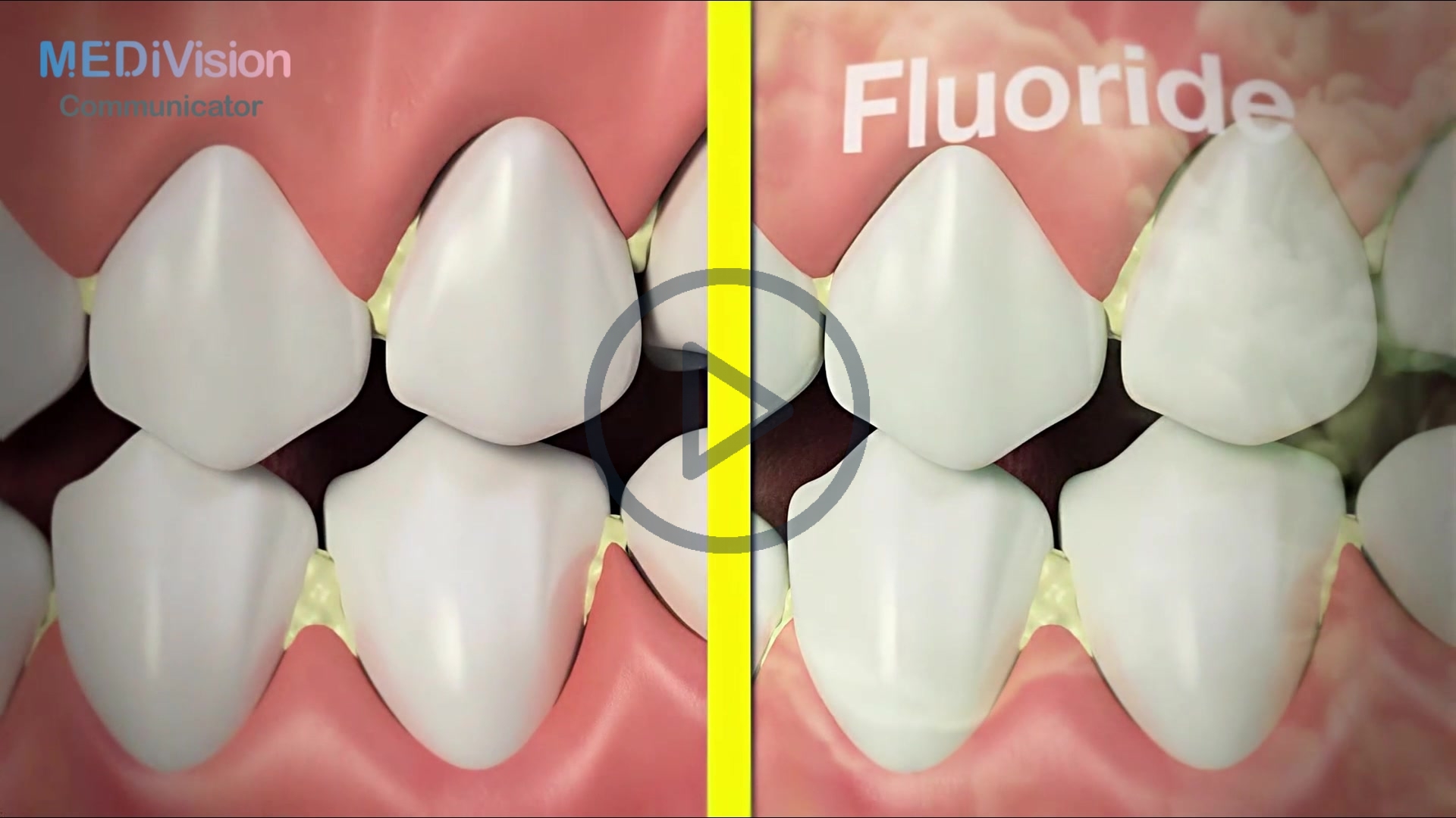 Fluoride
