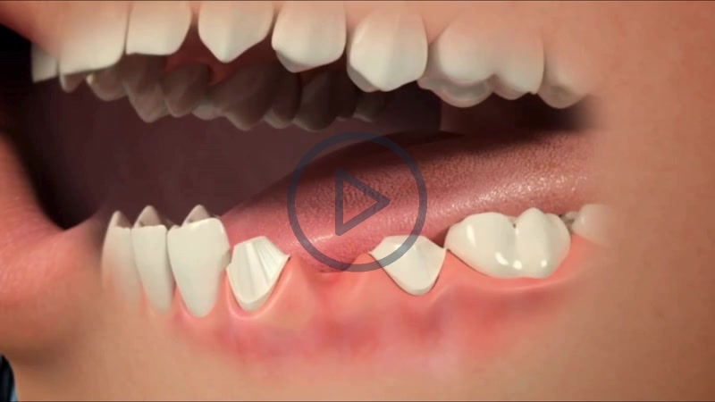 Missing Tooth Options (Posterior)