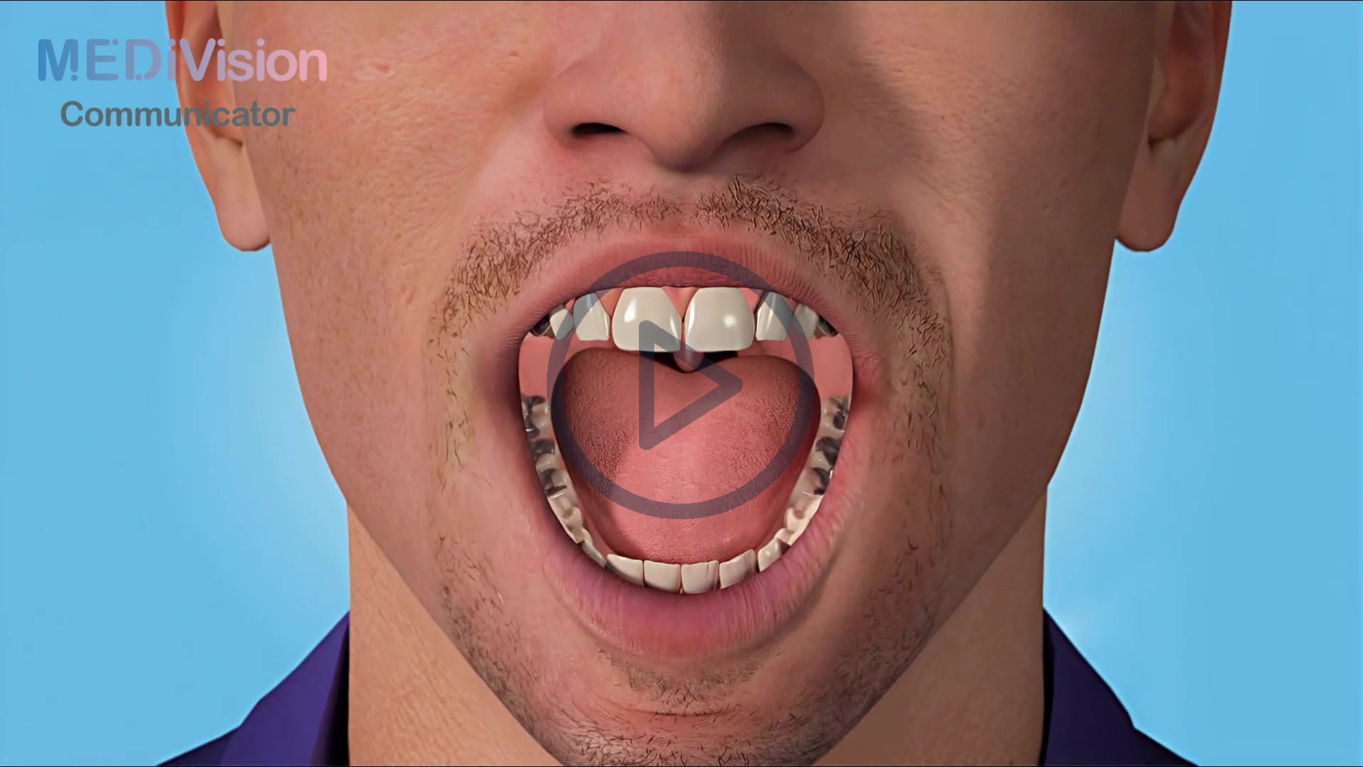 Amalgam to Composite