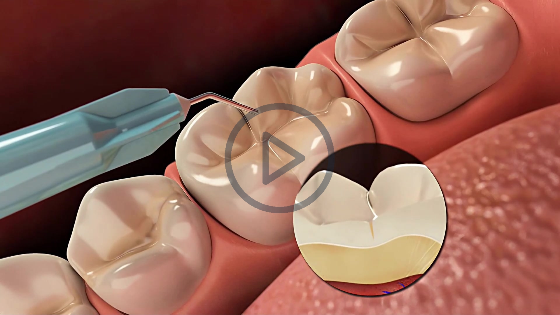 Fissure Sealants