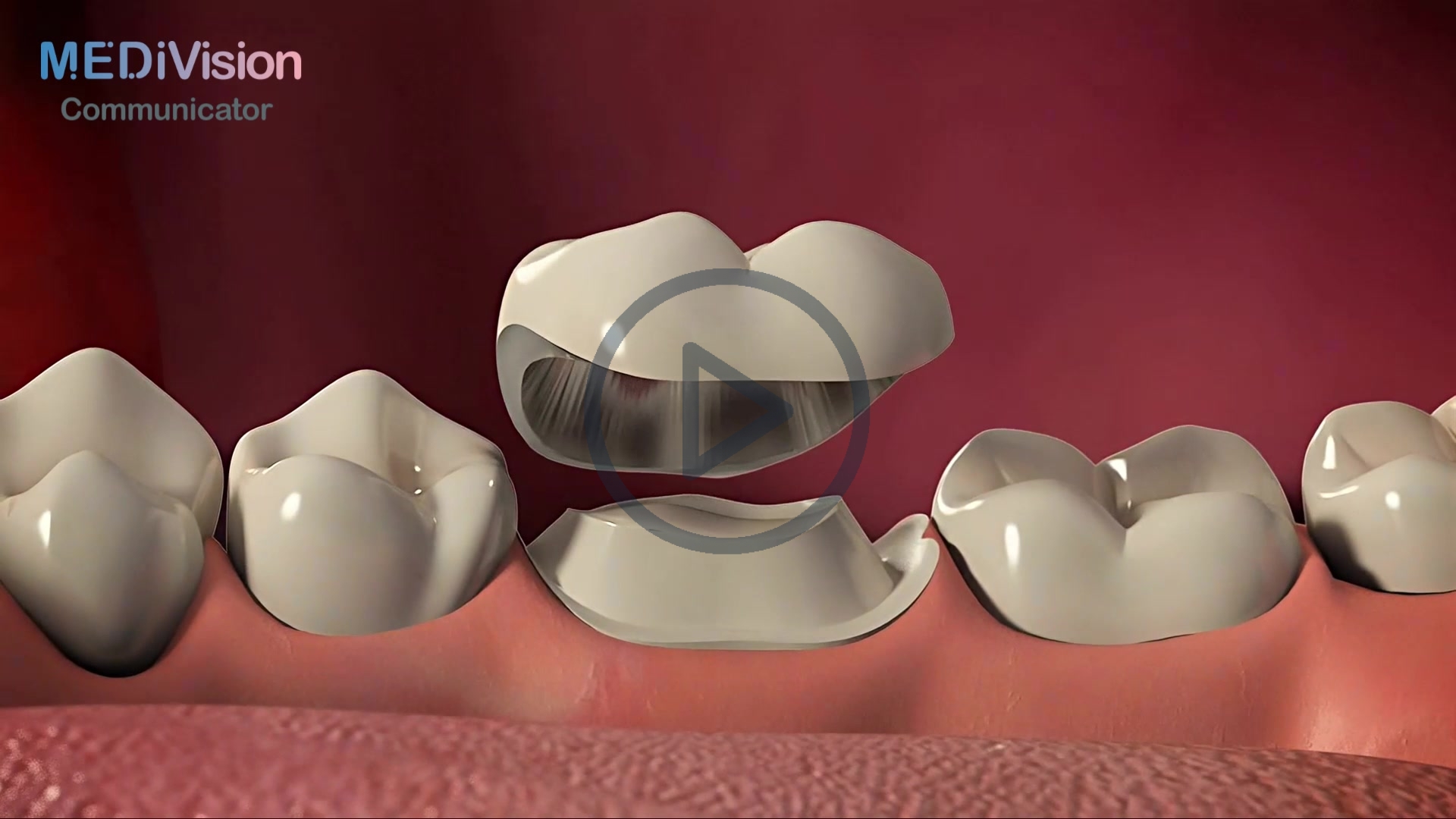 Posterior Crown