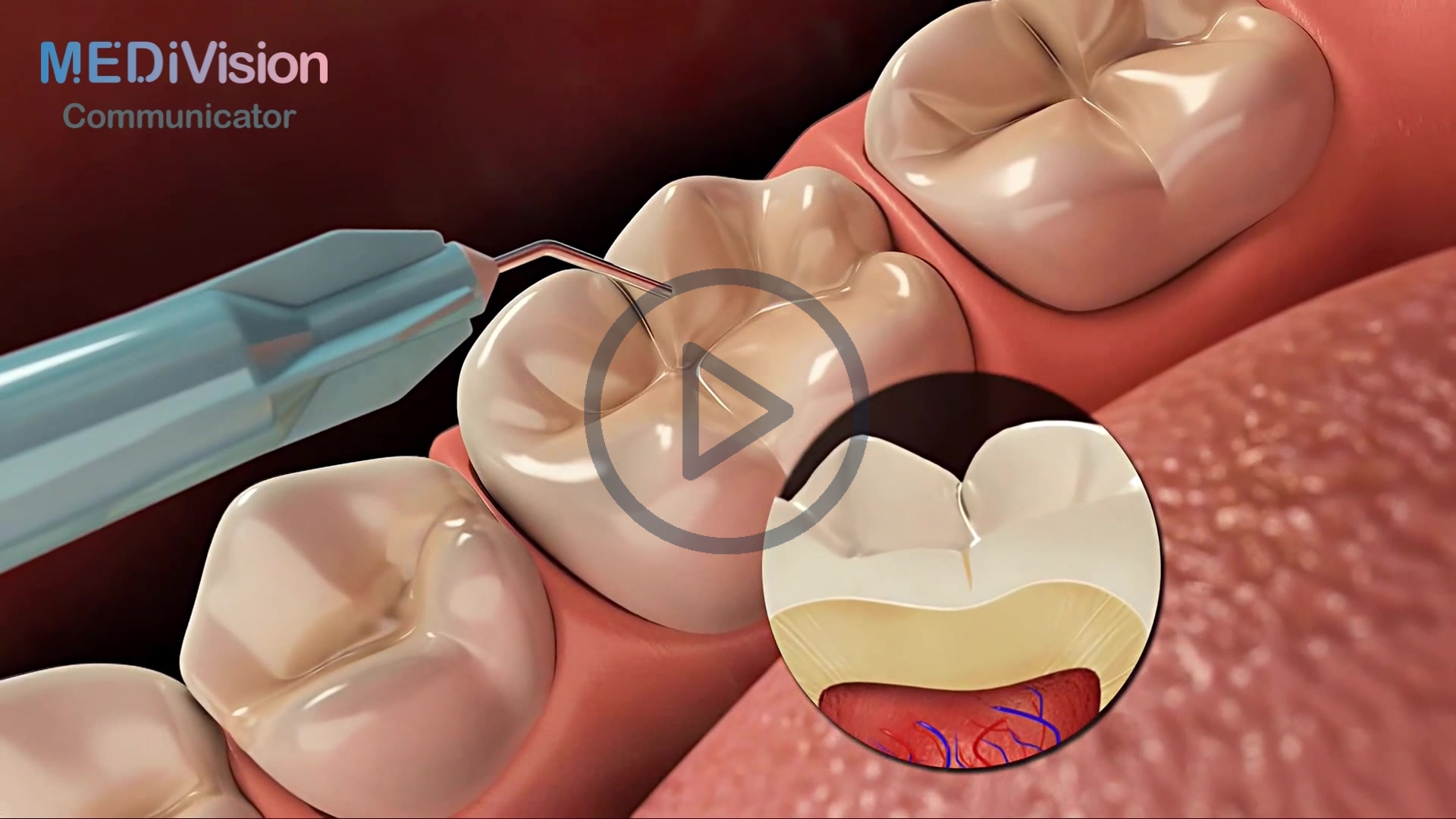 Fissure Sealants