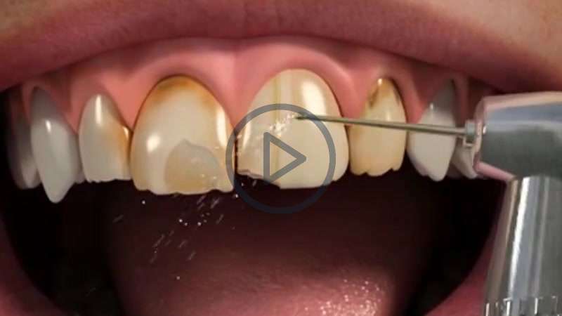 thumbnail image 2 of Temporary Teeth Veneers - 3 Sizes, 12 Positions, SL Ceramic For Anterior Whitening 2 of 10