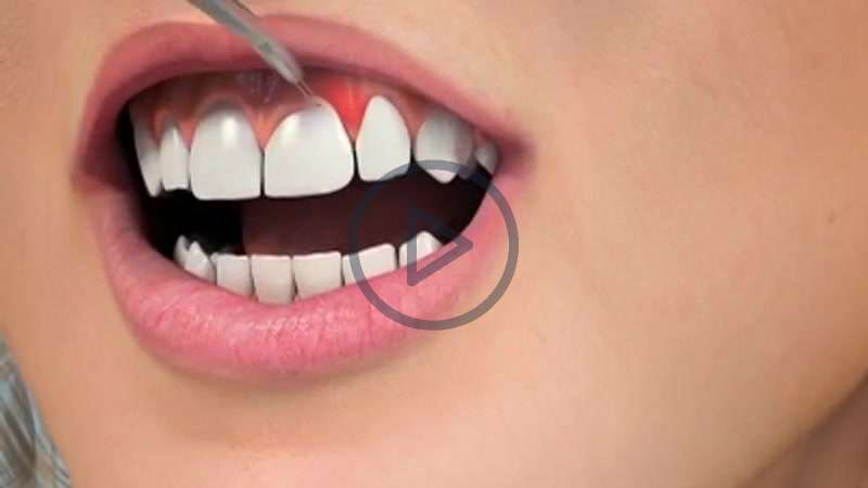 Tooth Lengthening