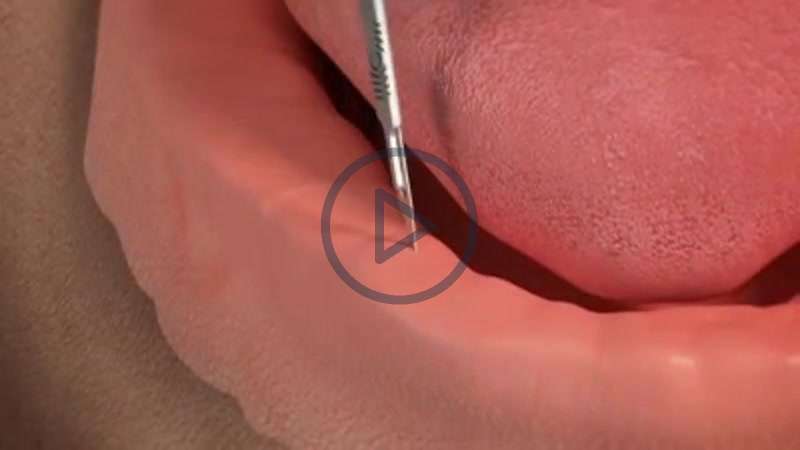 Implant Secured Denture
