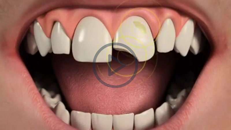 Chipped Tooth Options